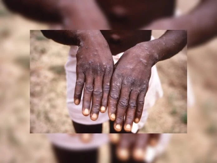 Se investiga un caso sospechoso de viruela del mono en la frontera con Misiones