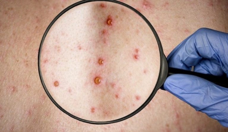 Viruela del mono | “Misiones está preparada para afrontar la enfermedad”, sostuvo Oscar Alarcón