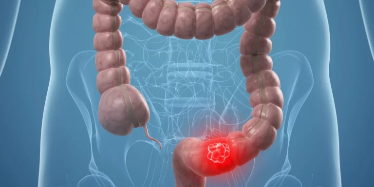 Cáncer de colon: Misiones es pionera en la prevención y un sistema de salud equitativo